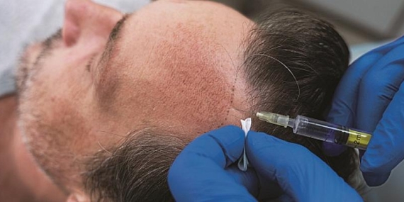 Hasarlı dokulara hastanın kendi onarıcı hücreleri ile tedavi