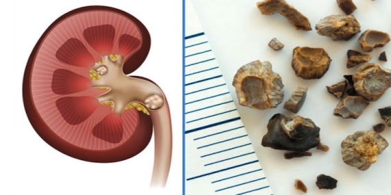 Böbrek Taşları Hakkında Bilmeniz Gereken Her Şey