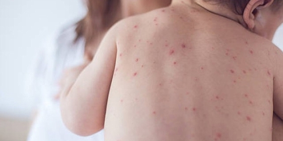 Vakalar artıyor! 1 yaş altı bebekler ağır kızamık için risk altında!