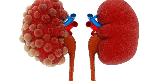 Abdi İbrahim Otsuka Medikal Direktörlüğü: Polistik Böbrek Hastalığının Seyrini Değiştirmek Mümkün