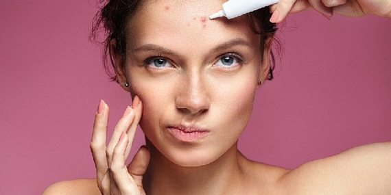 Akne tedavisinde yapılan 10 önemli hata !