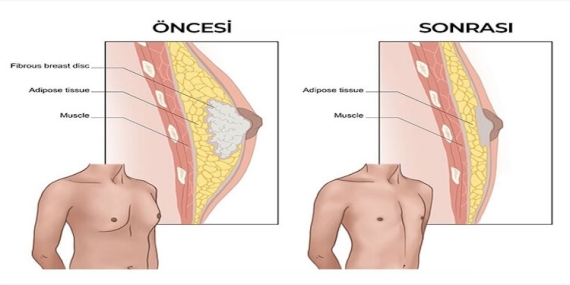 Erkekte Meme Büyümesi (Jinekomasti) ve Tedavisi