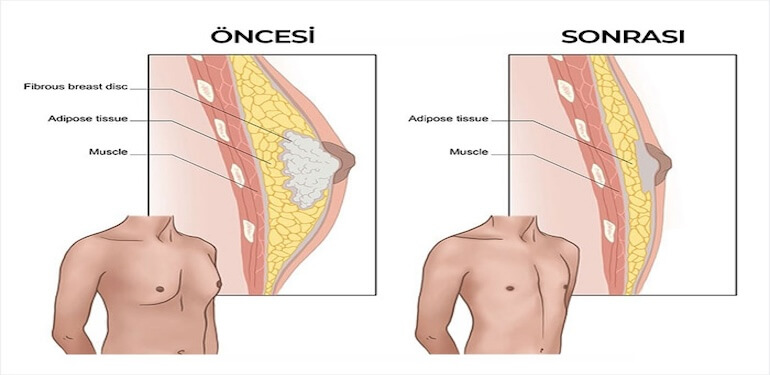 Erkekte Meme Büyümesi (Jinekomasti) ve Tedavisi