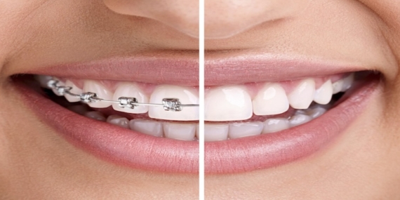 Diş Teli Fiyatları Nasıl Belirlenir?