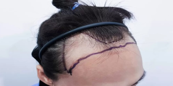 Kadınlarda Saç Ekimi