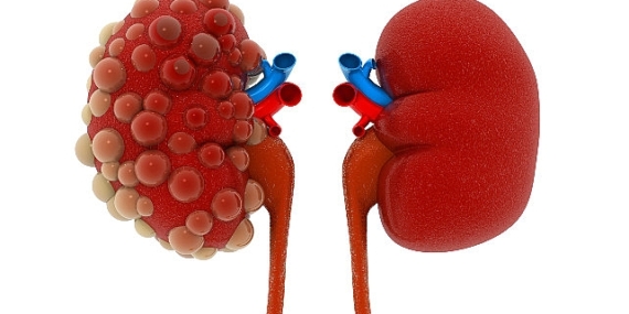 Polikistik böbrek hastalığı yavaş gelişir, her şey hızla değişir