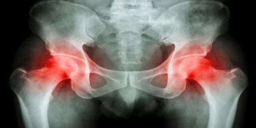 Kalça Kireçlenmesi Hakkında Bilmeniz Gereken Her Şey