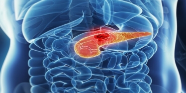 Pankreas Kanseri: Belirtiler, Tanı ve Tedavi Yöntemleri