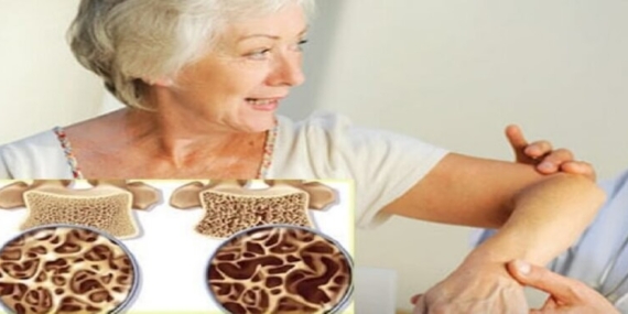 Kemik Erimesi: Osteoporoz Hakkında Bilmeniz Gereken Her Şey