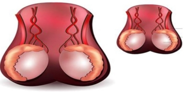 Testis Kanseri Hakkında Bilmeniz Gereken Her Şey