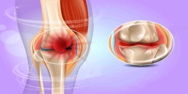 Diskoid Menisküs Nedir