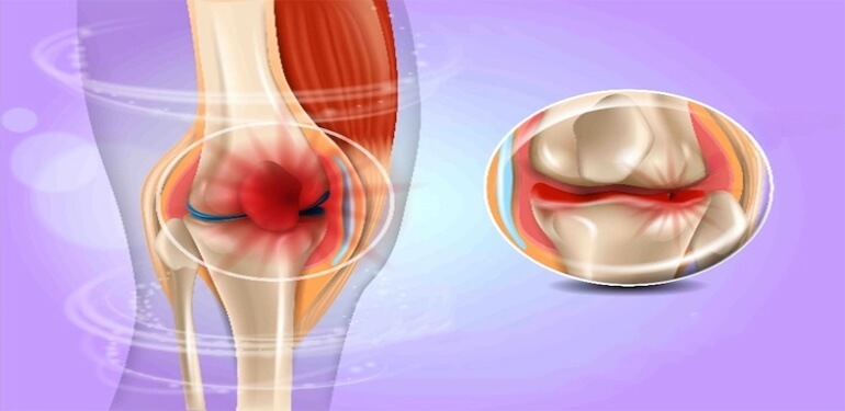 Diskoid Menisküs Nedir