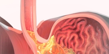 Gastroözofageal Reflü Nedir