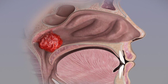 Geniz Eti Büyümesi: Belirtileri, Nedenleri ve Tedavisi