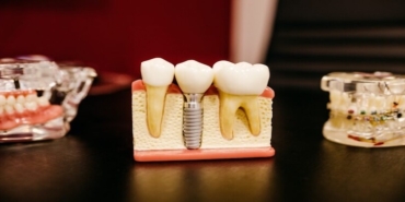 Eksik Dişlerinize Kalıcı Çözüm: İmplant Tedavisi Hakkında Bilmeniz Gerekenler