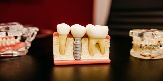 Eksik Dişlerinize Kalıcı Çözüm: İmplant Tedavisi Hakkında Bilmeniz Gerekenler