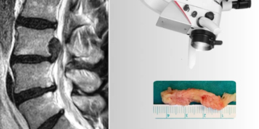 Bel Fıtığı Ameliyatı