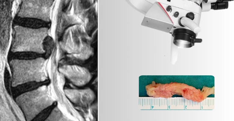 Bel Fıtığı Ameliyatı