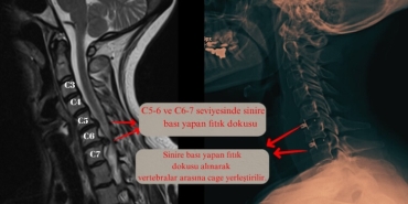 Boyun Fıtığı Ameliyatı Ne Zaman Gerekir?