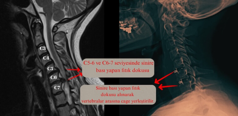 Boyun Fıtığı Ameliyatı Olmadan Önce Bilinmesi Gerekenler