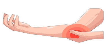 Kubital Tünel Sendromu: Dirsekte Sinir Sıkışması