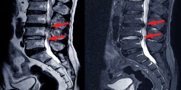 Yaşlılığı Bekleyen Gizli Tehlike: Kanal Darlığı