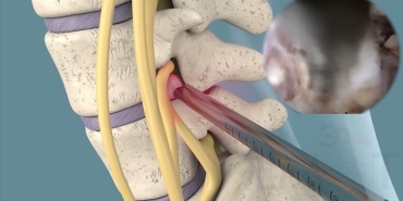 Kapalı Bel Fıtığı Ameliyatı Nedir?