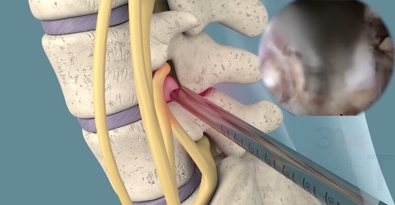 Kapalı Bel Fıtığı Ameliyatı Nedir?