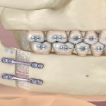 Ortognatik Cerrahi Ameliyatı