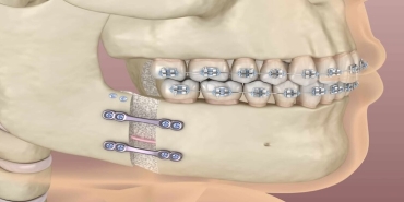 Ortognatik Cerrahi Ameliyatı