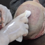 En İyi Saç Ekim Metodu Hangisidir?