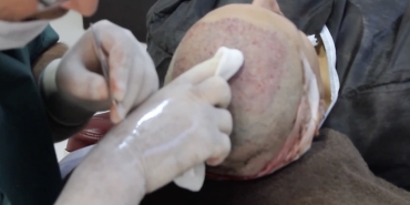 En İyi Saç Ekim Metodu Hangisidir?