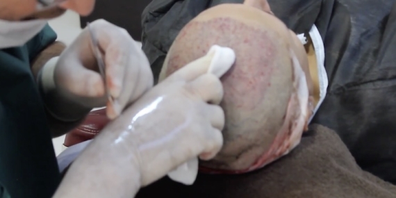 En İyi Saç Ekim Metodu Hangisidir?