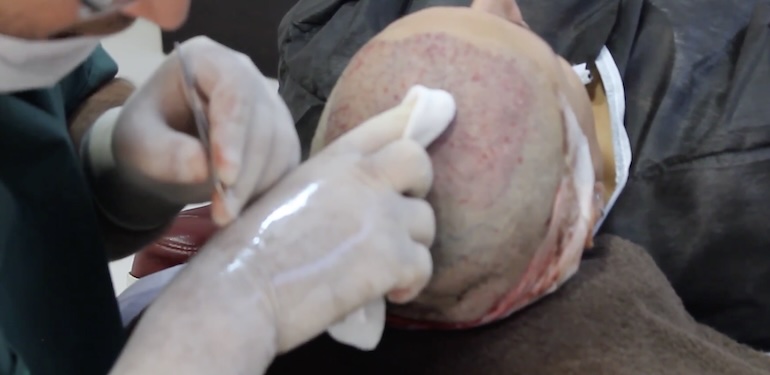 En İyi Saç Ekim Metodu Hangisidir?